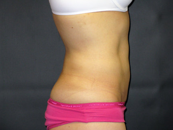 Liposuction of the Abdomen and Flanks 336541