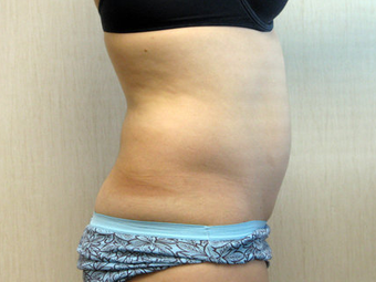 Liposuction of the Abdomen and Flanks 336541
