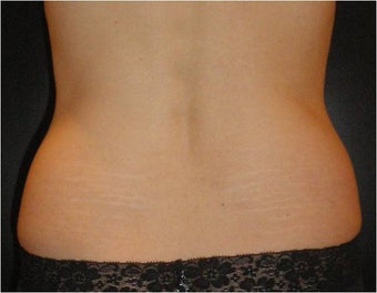 SmartLipo MPX before 686087