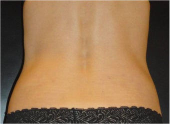 SmartLipo MPX after 686087