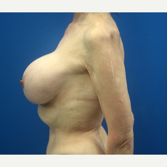 65-74 year old woman treated with Breast Implant Revision after 3366560