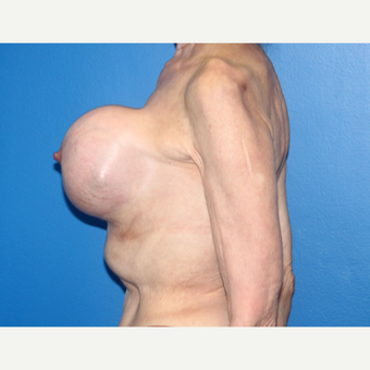 65-74 year old woman treated with Breast Implant Revision before 3366560