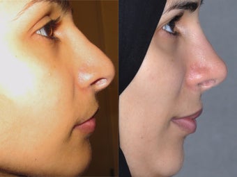 Second Revision for 2 failed rhinoplasties by other surgeons. Complete reconstruction Nosejob before 1521365