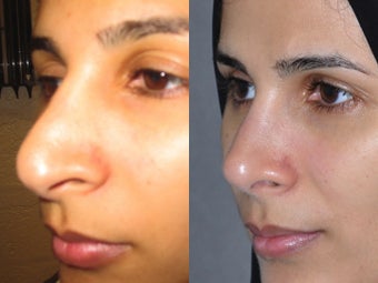 Second Revision for 2 failed rhinoplasties by other surgeons. Complete reconstruction Nosejob after 1521365