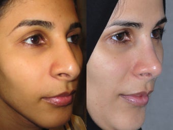 Second Revision for 2 failed rhinoplasties by other surgeons. Complete reconstruction Nosejob 1521365