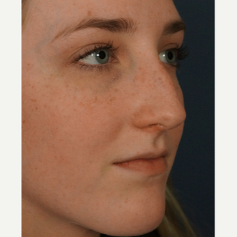 18-24 year old woman treated with Rhinoplasty before 3245071