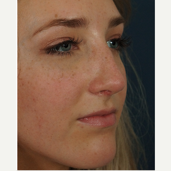 18-24 year old woman treated with Rhinoplasty after 3245071
