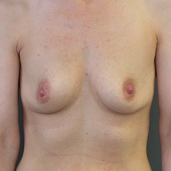 35-44 year old woman treated with Inspira Breast Implants 3446411