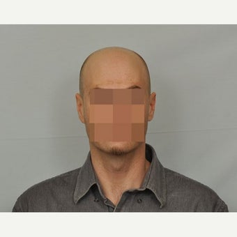 35-44 year old man treated with FUE Hair Transplant before 1631218