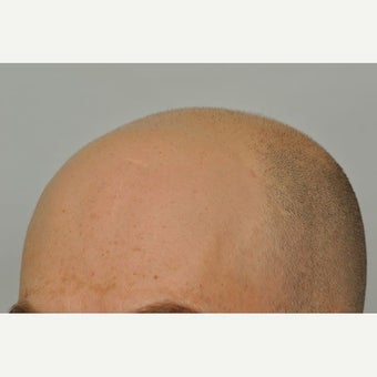 35-44 year old man treated with FUE Hair Transplant 1631218