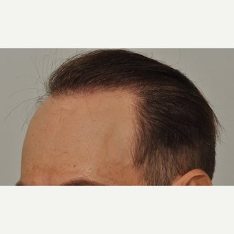 35-44 year old man treated with FUE Hair Transplant 1631218