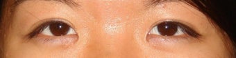 Bilateral Asian Eyelid Surgery after 861047