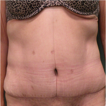 55-64 year old woman treated with Tummy Tuck after 2730311