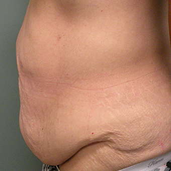55-64 year old woman treated with Tummy Tuck 2730311