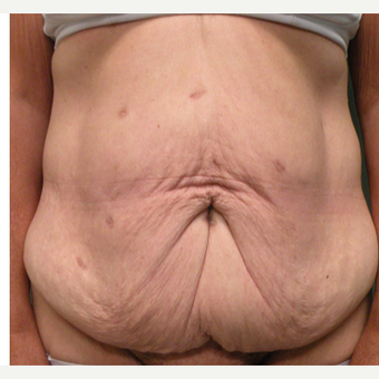 55-64 year old woman treated with Tummy Tuck before 2730311