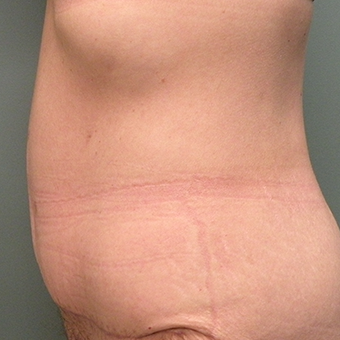 55-64 year old woman treated with Tummy Tuck 2730311