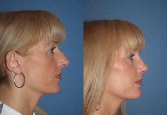 Revision Nasal Surgery before 418277