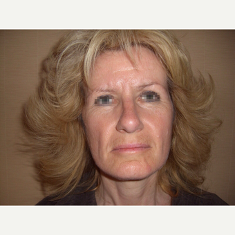 45-54 year old woman treated with Rhinoplasty after 3122825