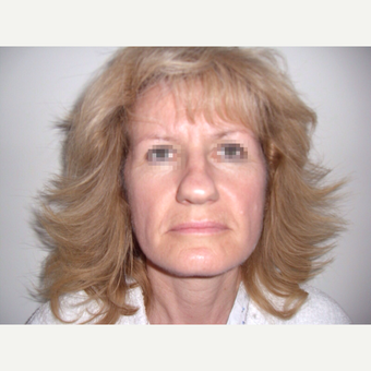 45-54 year old woman treated with Rhinoplasty before 3122825