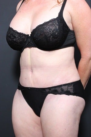 This 45 year old woman underwent a full tummy tuck to repair liposuction irregularity 1404389