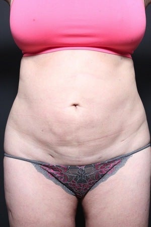 This 45 year old woman underwent a full tummy tuck to repair liposuction irregularity before 1404389