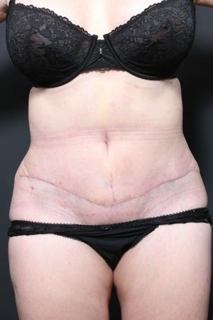 This 45 year old woman underwent a full tummy tuck to repair liposuction irregularity after 1404389