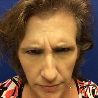 45-54 year old woman treated with Botox before 3405975