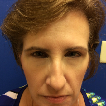 45-54 year old woman treated with Botox after 3405975