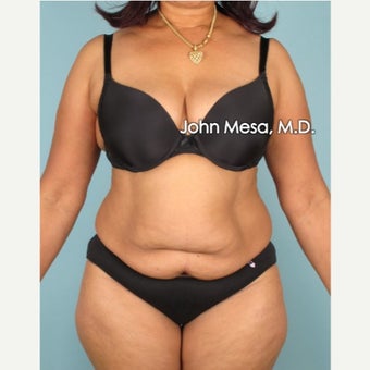 35-44 year old woman treated with Brazilian Tummy Tuck (LipoAbdominoplasty) before 1918447