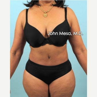 35-44 year old woman treated with Brazilian Tummy Tuck (LipoAbdominoplasty) after 1918447