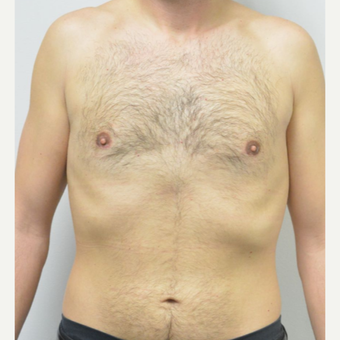 25-34 year old man treated with Male Breast Reduction after 3683756