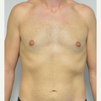 25-34 year old man treated with Male Breast Reduction before 3683756