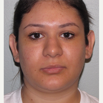 18-24 year old woman treated with Ear Surgery before 3140192