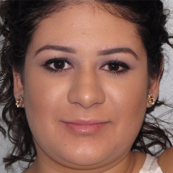 18-24 year old woman treated with Ear Surgery after 3140192