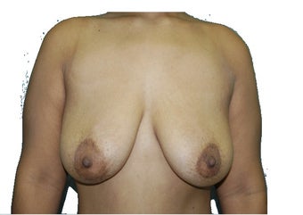 6 Month Post Operative Breast Lift before 1100165
