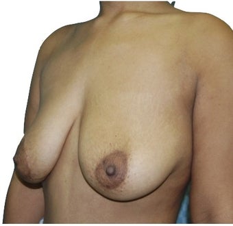 6 Month Post Operative Breast Lift 1100165