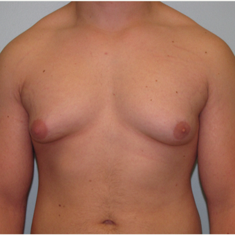 18-24 year old man treated with Male Breast Reduction before 3643990