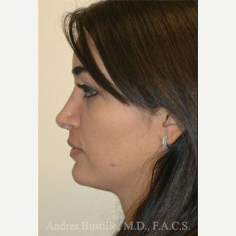 31 year old woman treated with Rhinoplasty after 3462441