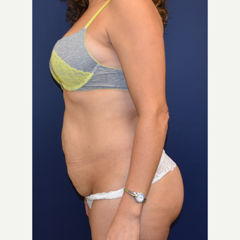 35-44 year old woman treated with Liposuction before 3213953