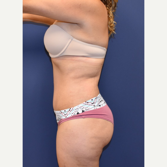 35-44 year old woman treated with Liposuction after 3213953