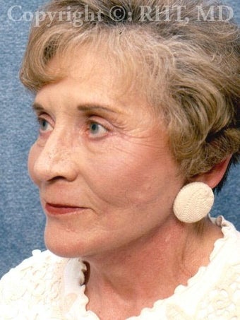 Forehead lift, SMAS facelift, platysmaplasty, upper and lower eyelid lifts after 254843