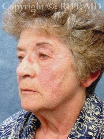 Forehead lift, SMAS facelift, platysmaplasty, upper and lower eyelid lifts before 254843