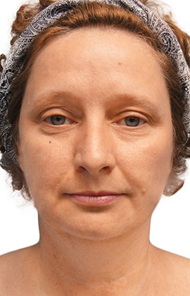 Facelift, Neck liposuction and lift, Endoscopic Browlift, Upper Blepharoplasty (eyelid lift) before 319997