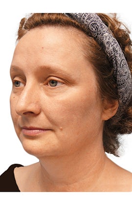 Facelift, Neck liposuction and lift, Endoscopic Browlift, Upper Blepharoplasty (eyelid lift) 319997