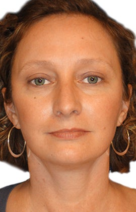 Facelift, Neck liposuction and lift, Endoscopic Browlift, Upper Blepharoplasty (eyelid lift) after 319997