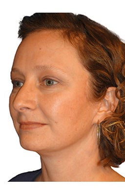 Facelift, Neck liposuction and lift, Endoscopic Browlift, Upper Blepharoplasty (eyelid lift) 319997