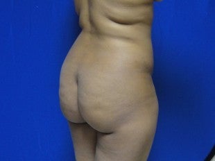 37 year old Brazilian Butt Lift - 2nd view before 1069862
