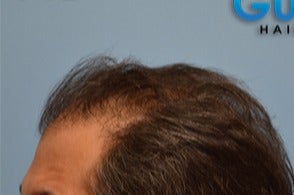 35-44 year old man treated with FUE Hair Transplant before 3604718