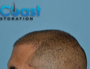 35-44 year old man treated with FUE Hair Transplant after 3604718