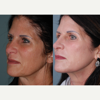 45-54 year old woman treated with Fraxel Laser before 3642888